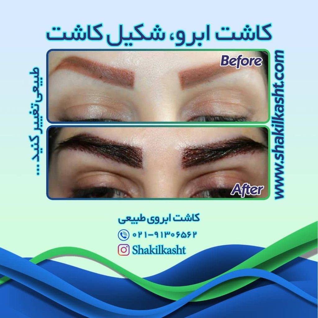 کاشت ابرو