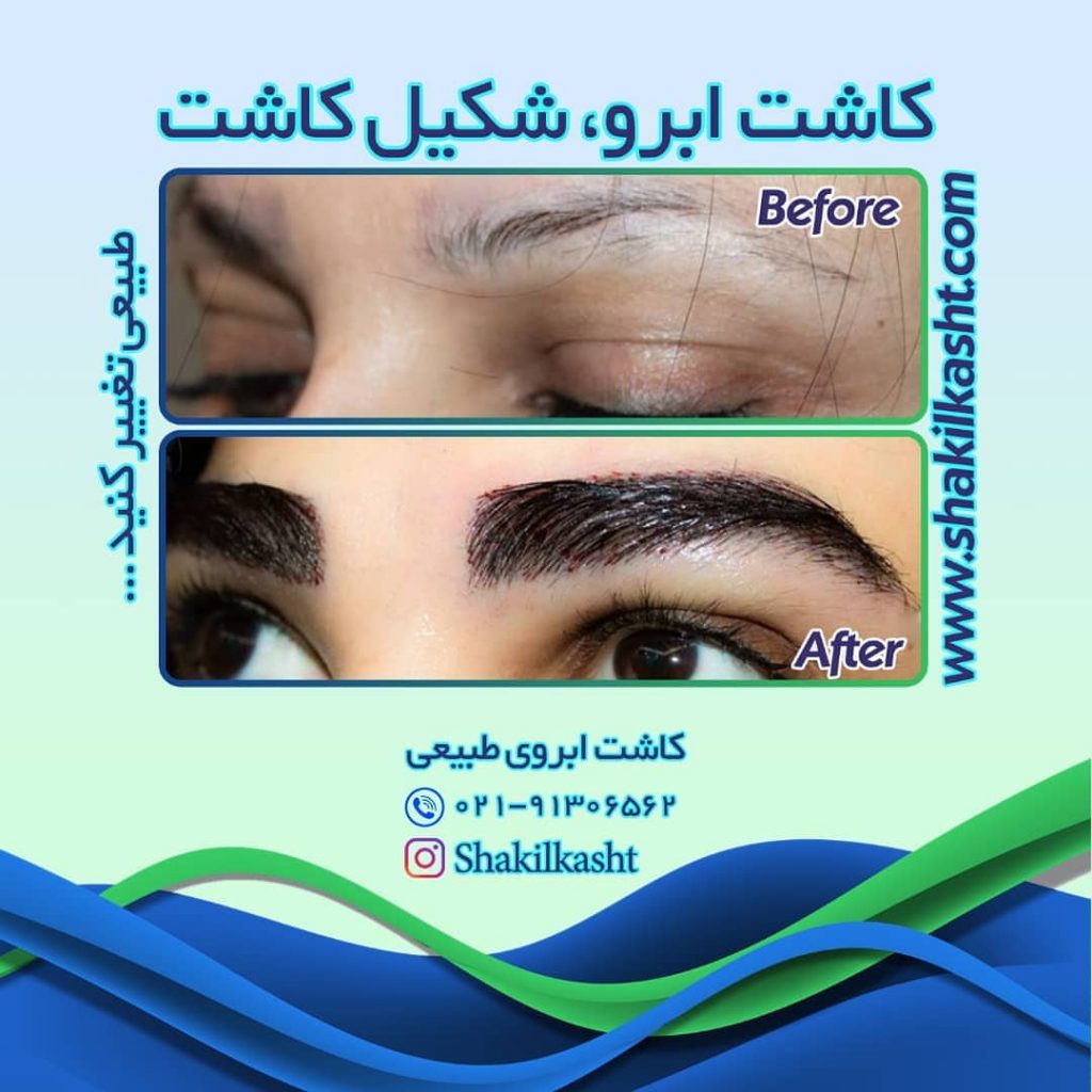 کاشت ابرو