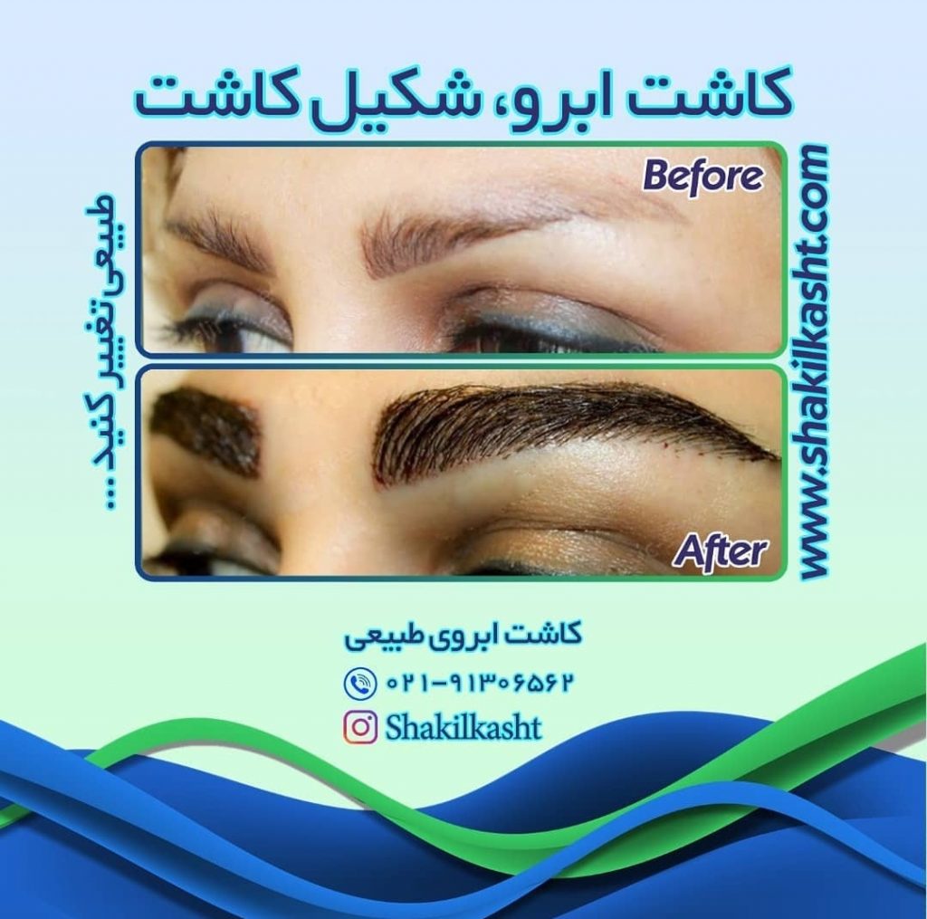 کاشت ابرو