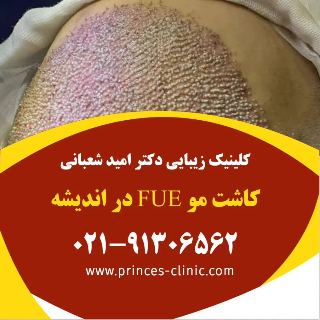 کاشت مو FUE در اندیشه در کلینیک زیبایی پرنسس