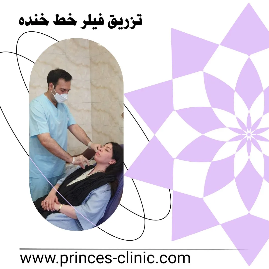 تزریق فیلر خط خنده در کلینیک دکتر امید شعبانی
