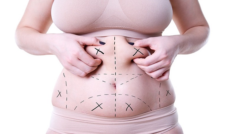 جراحی شکم ابدومینوپلاستی در اندیشه