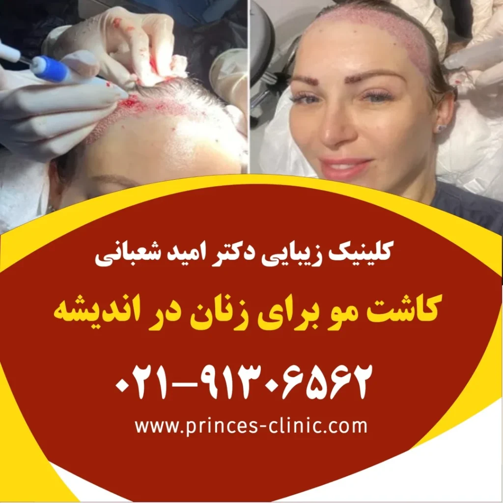 کاشت مو برای زنان در اندیشه در کلینیک زیبایی پرنسس