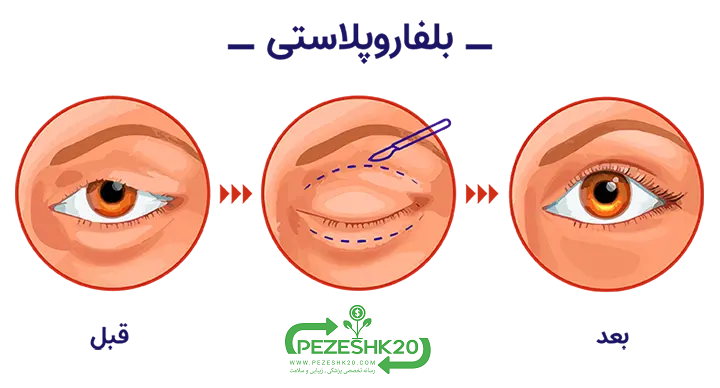 بلفاروپلاستی