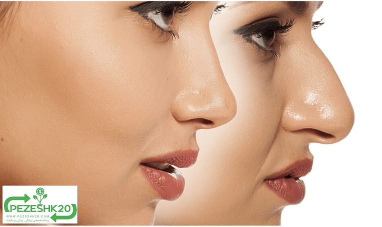 آنزیم بینی