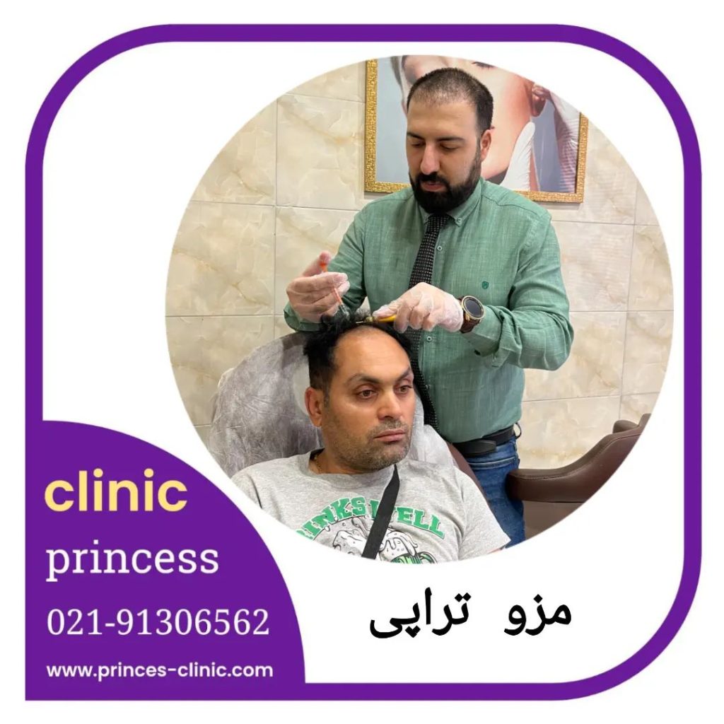مزوتراپی مو