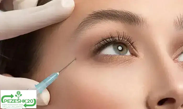 بوتاکس دور چشم