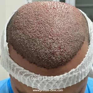 کاشت مو