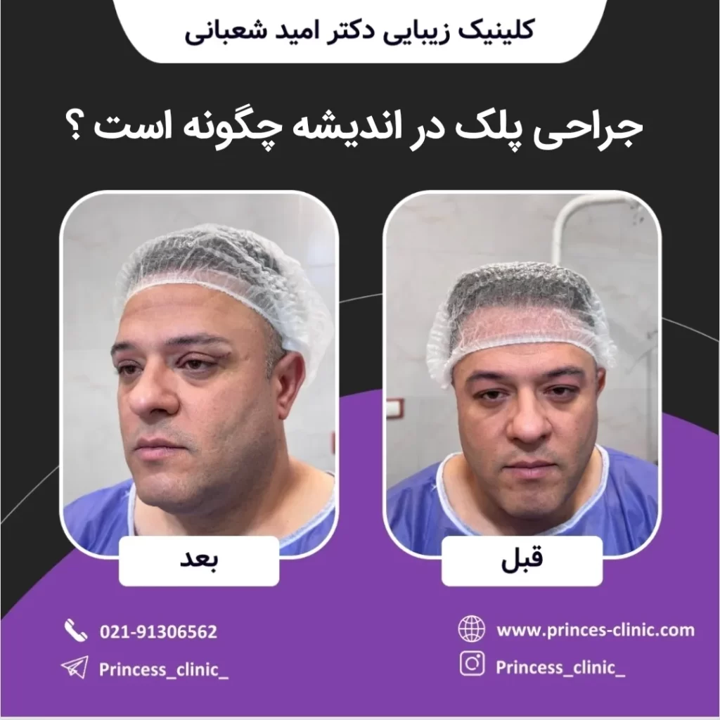 جراحی پلک در اندیشه چگونه است