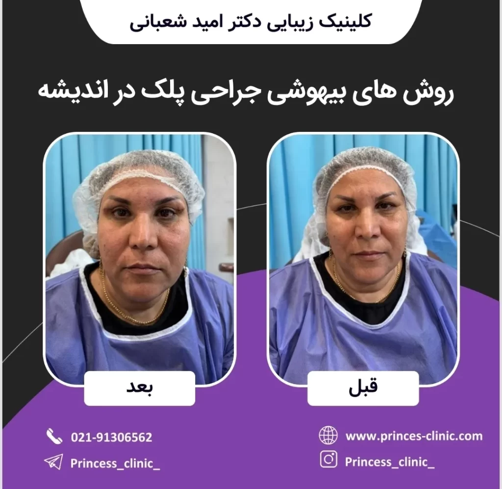 روش های بیهوشی جراحی پلک در اندیشه