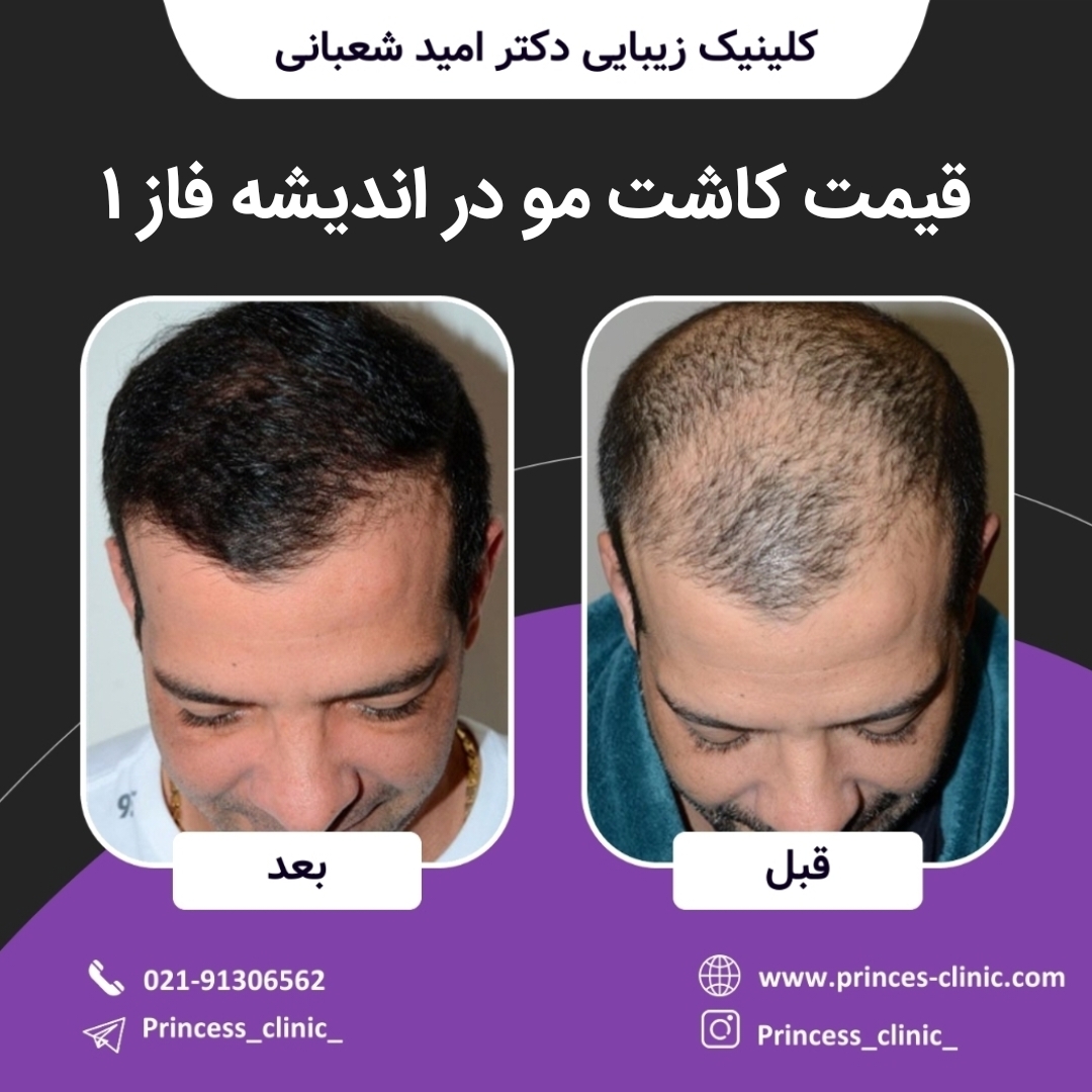 قیمت کاشت مو در اندیشه فاز یک ۱