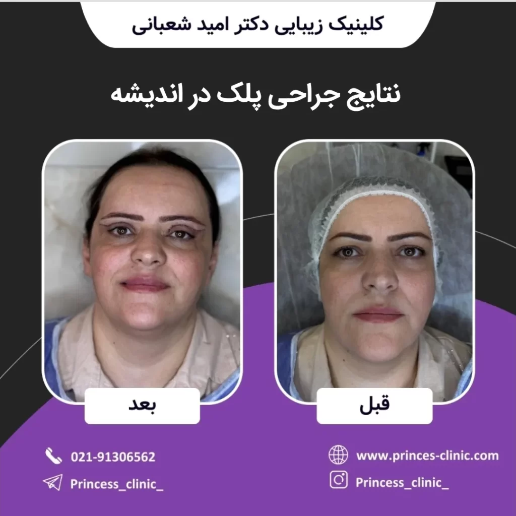 نتایج جراحی پلک در اندیشه
