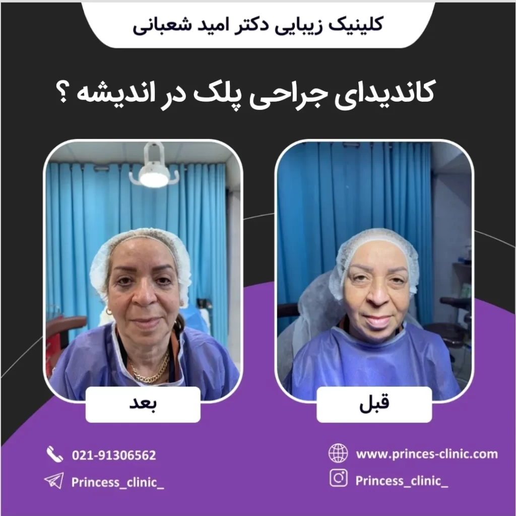کاندیدای جراحی پلک در اندیشه