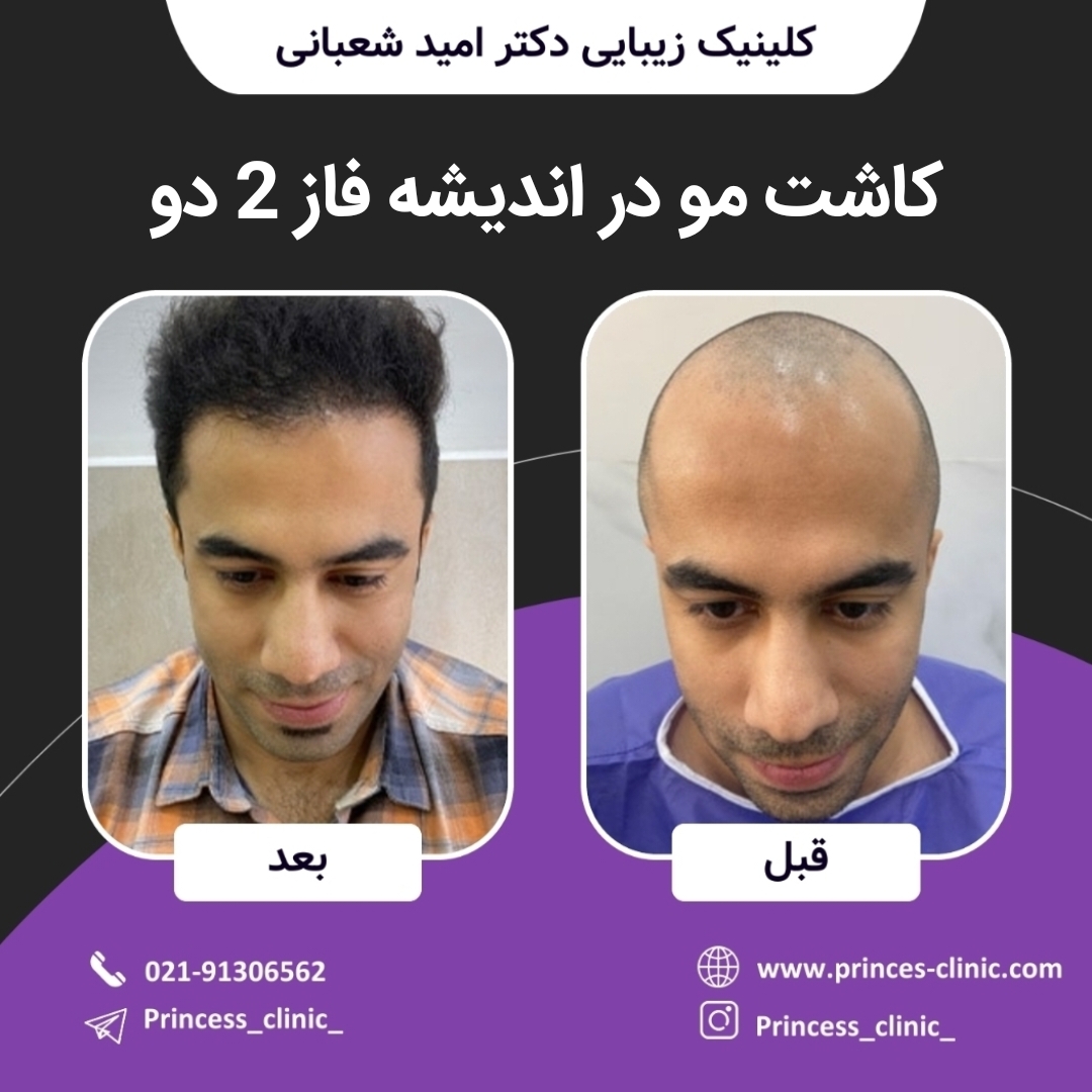 کاشت مو در اندیشه فاز 2 (فاز دو)