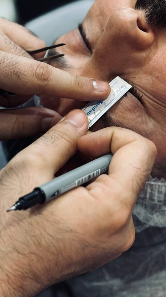 بلفاروپلاستی