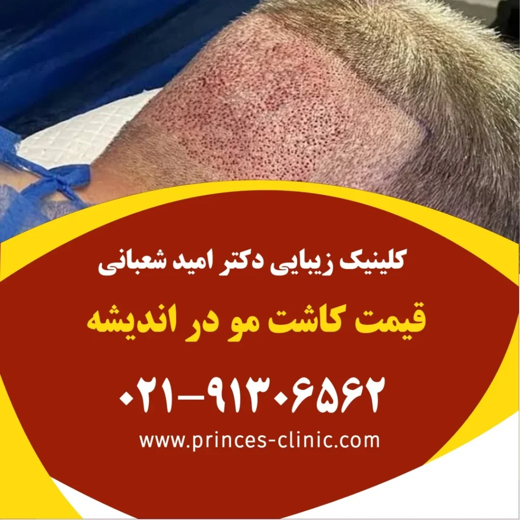 قیمت کاشت مو در اندیشه در کلینیک زیبایی پرنسس