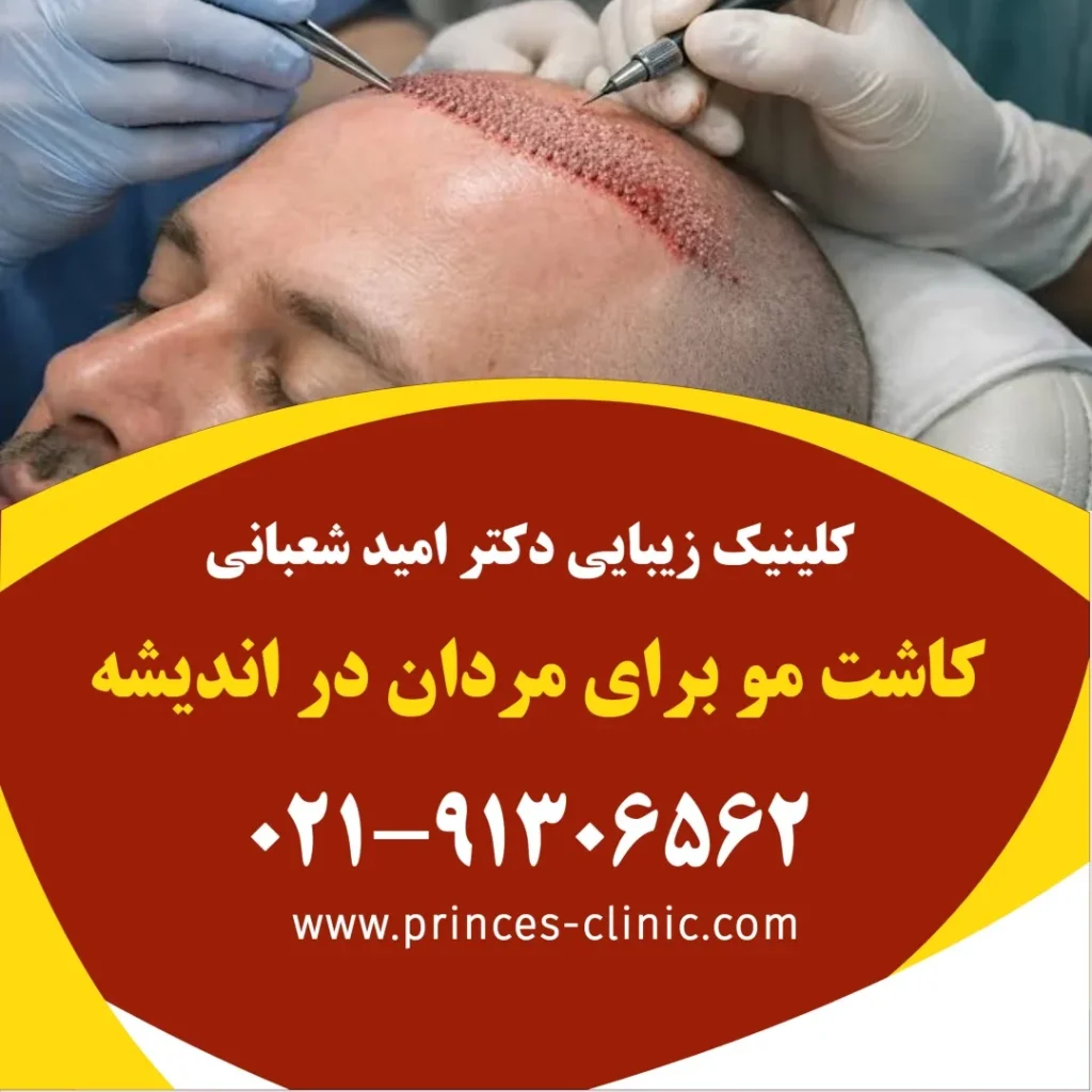 کاشت مو برای مردان در اندیشه در کلینیک زیبایی پرنسس