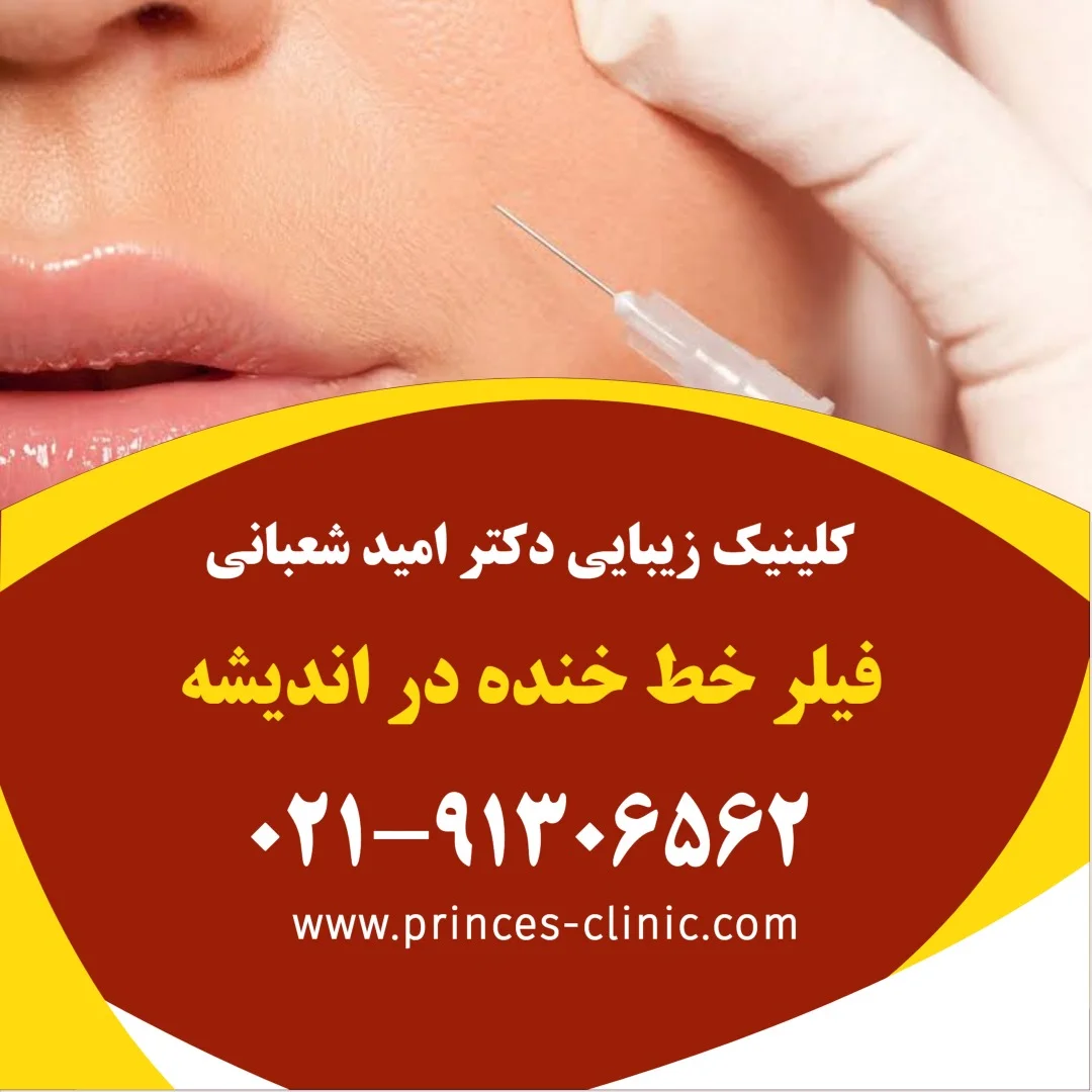 فیلر خط خنده در اندیشه در کلینیک زیبایی پرنسس