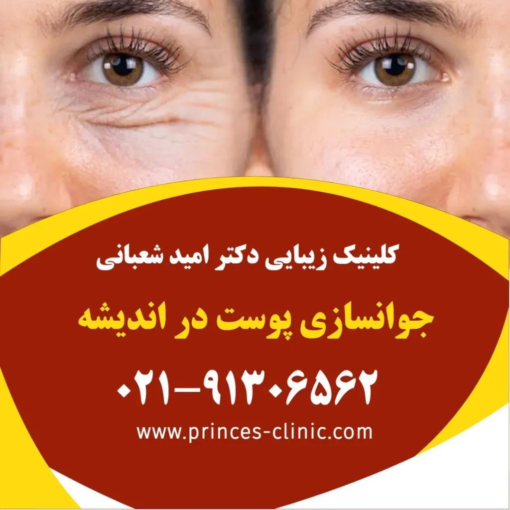 جوانسازی پوست در اندیشه در کلینیک زیبایی پرنسس