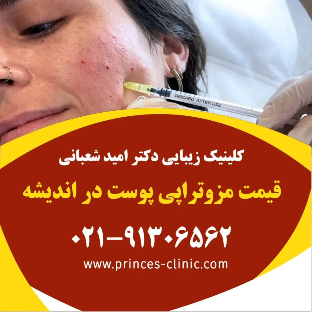 قیمت مزوتراپی پوست در اندیشه در کلینیک زیبایی پرنسس