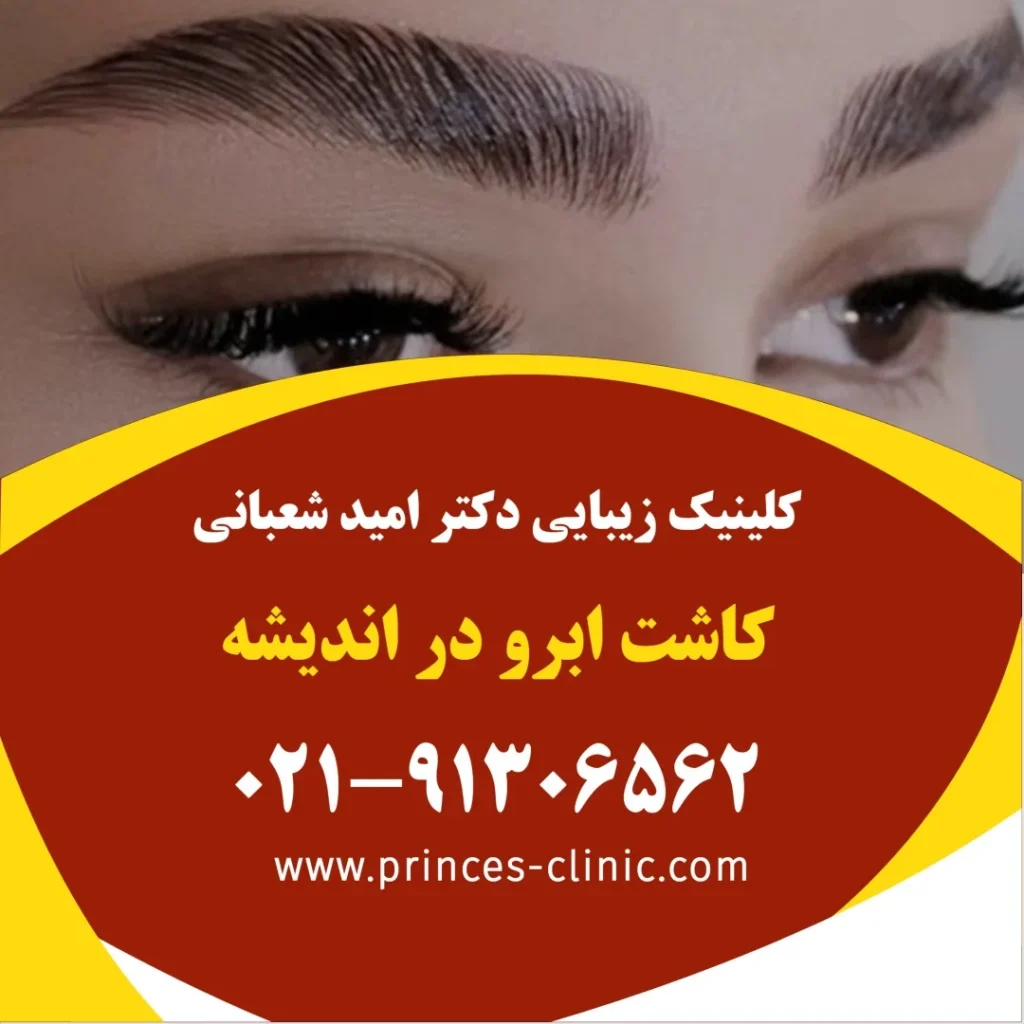 کاشت ابرو در اندیشه در کلینیک زیبایی پرنسس
