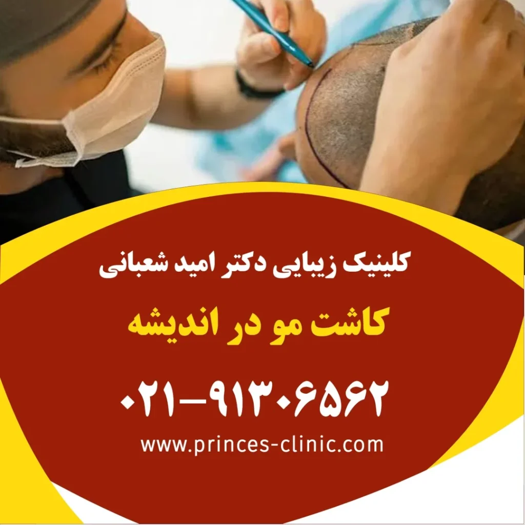 کاشت مو در اندیشه در کلینیک زیبایی پرنسس