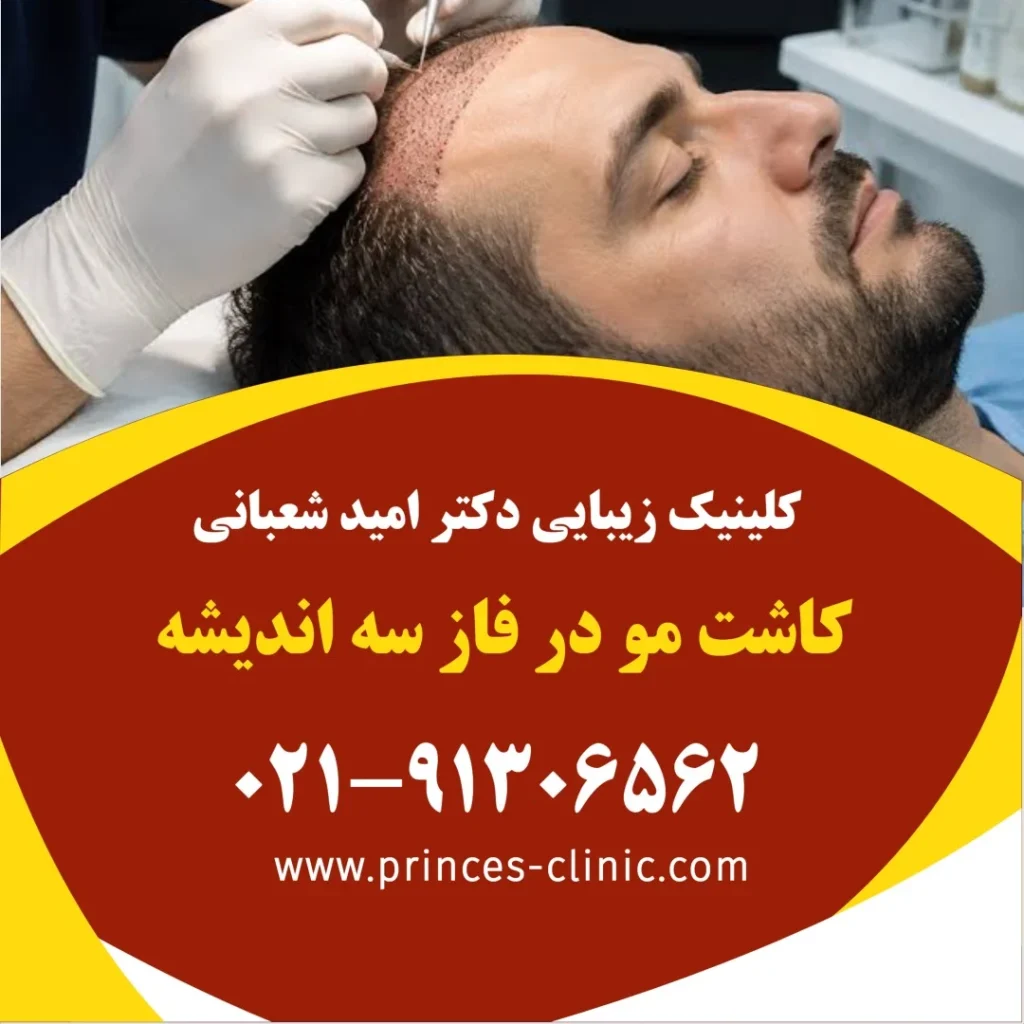کاشت مو در فاز سه اندیشه در کلینیک زیبایی پرنسس