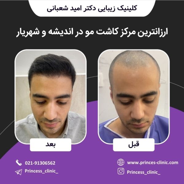 بهترین مرکز کاشت مو در اندیشه و شهریار