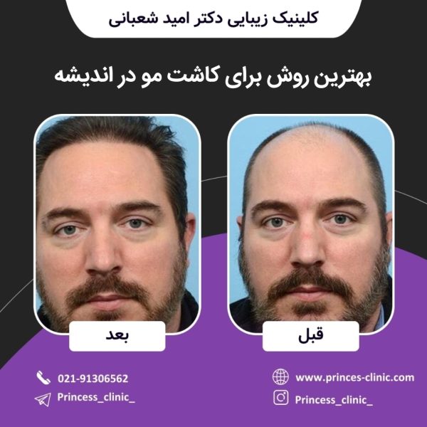 بهترین روش برای کاشت مو در اندیشه