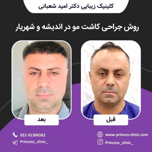 روش جراحی کاشت مو در اندیشه و شهریار
