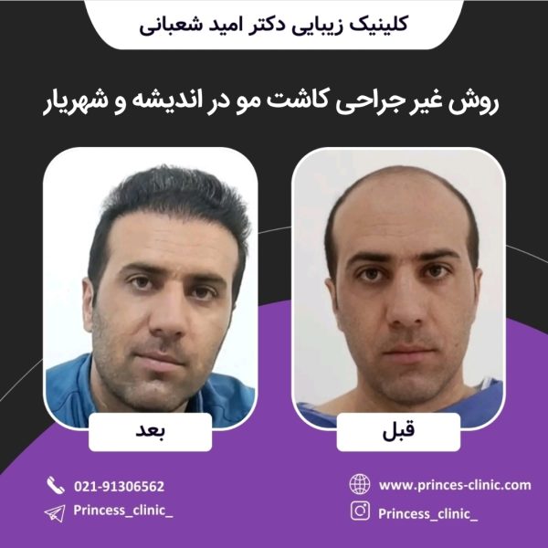 روش غیر جراحی کاشت مو در اندیشه و شهریار