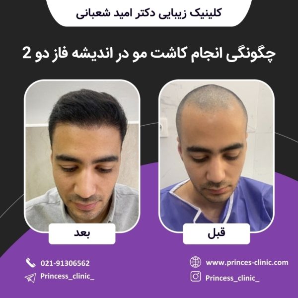 چگونگی انجام کاشت مو در اندیشه فاز دو 2