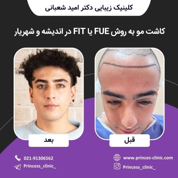 کاشت مو به روس FUE یا FIT در اندیشه و شهریار