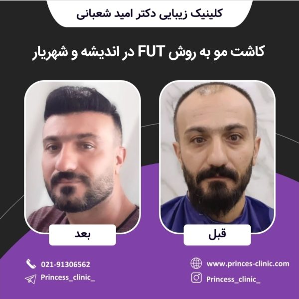 کاشت مو به روش FUT در اندیشه و شهریار