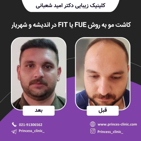 کاشت مو به روش SUT در اندیشه و شهریار