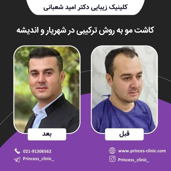 کاشت مو به روش ترکیبی در شهریار و اندیشه