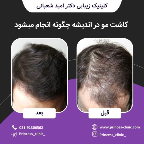کاشت مو در اندیشه چگونه انجام میشود